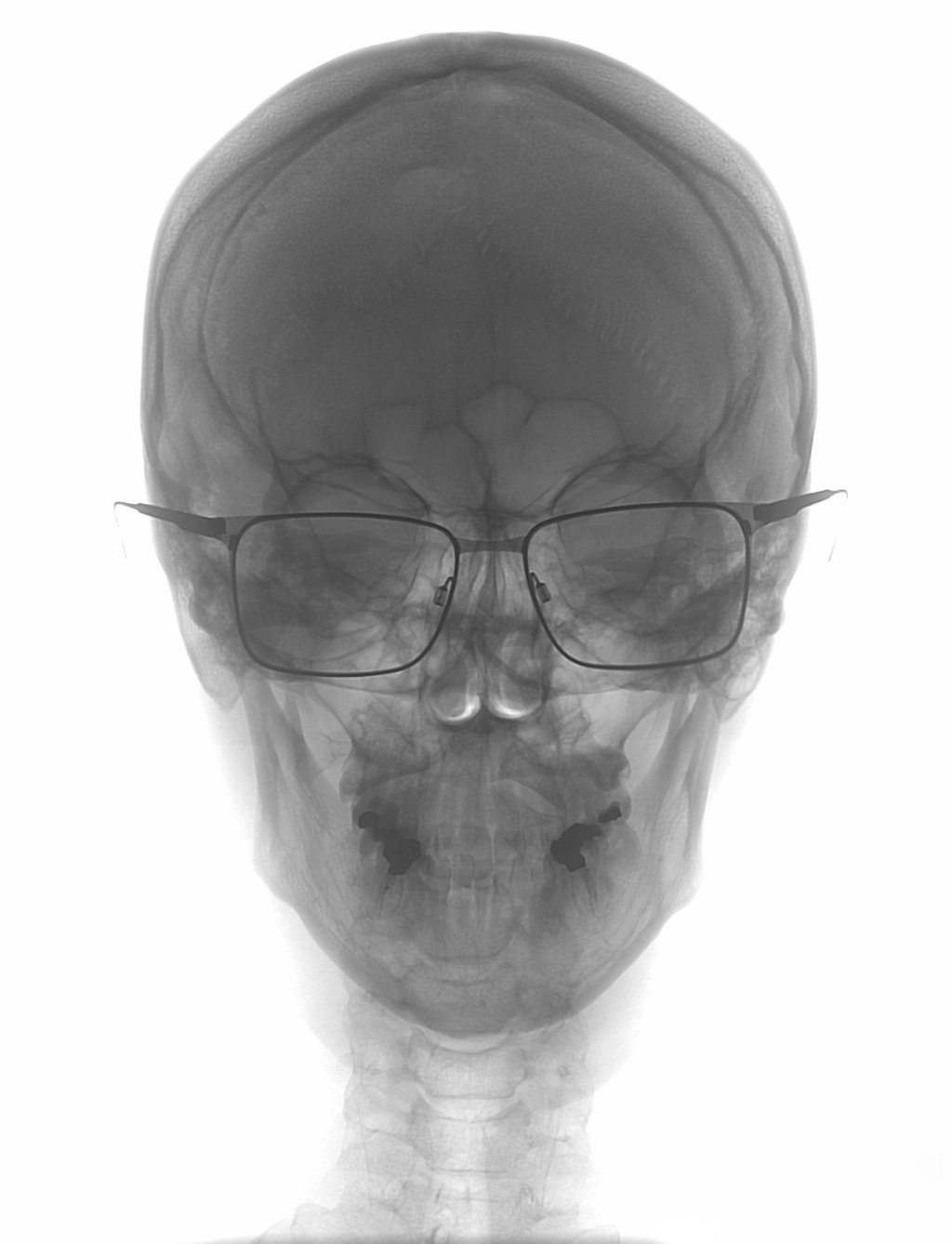 Savlovskis Janis MD, head X-Ray with glasses